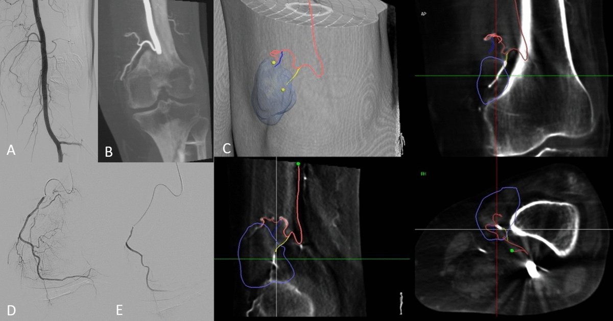 CVIR_Journal's tweet image. #LettertoEditor 📬
Usefulness of Cone-Beam Computed Tomography and Automatic Vessel Detection Software in Embolization for Osteoarthritis
link.springer.com/article/10.100…