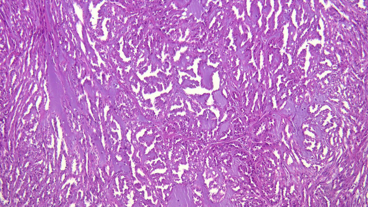 AUBMC_PATH's tweet photo. Case of the week #1 🔬
40F with a kidney mass. 

Can you guess the diagnosis?

#AUBMCPATH #Pathology #pathtwitter #GUpath https://t.co/07D3teZ3uQ