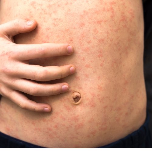 Si usted planea ir a algún partido del #Mundial2026 en #Mexico esto le interesa 👇
🚨#Sarampión 🚨

México llega al Mundial con brote activo de sarampión. Jalisco, #sedemundialista está entre los estados con más casos reportados, lo que eleva el riesgo sanitario en uno de los