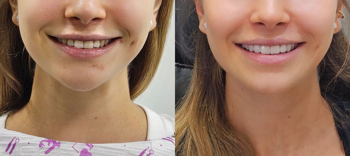 Tomigiachini's tweet photo. Carillas sin desgaste dental ! Sin tallado #Carillas https://t.co/crNwqAPOIc