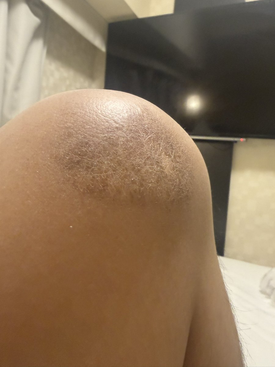 sokabokumetsu's tweet image. 創価学会員に車で轢かれた傷
見るたびに創価学会への怒りが湧いてきます