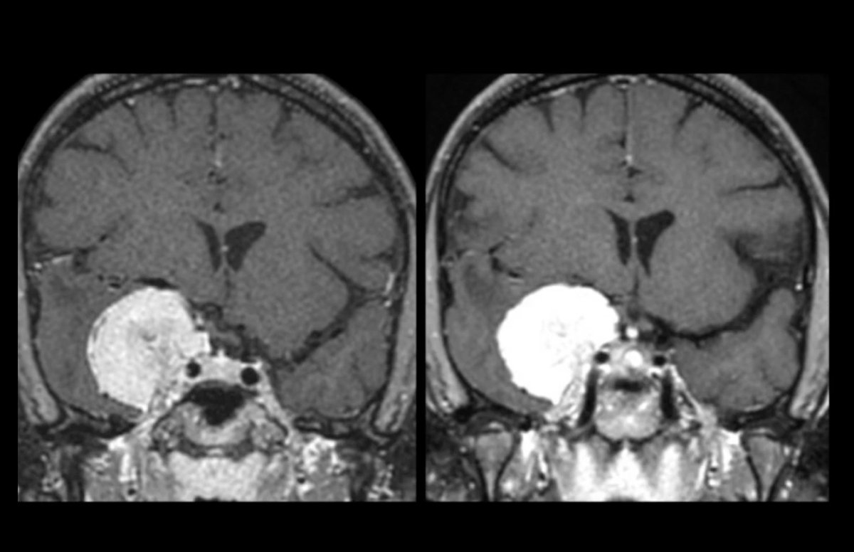 DrBaskaya's tweet photo. 🎥 New Neurosurg Focus Video (Jan 2026)
Microsurgical resection of anterior clinoidal meningiomas with arterial engulfment.
🧠 ICA/AChA encasement • ICG + neuromonitoring • Neurovascular preservation
🔗 https://t.co/RUl24WhpiJ
#Neurosurgery #SkullBase #Neurovascular https://t.co/RLckoWaYnP