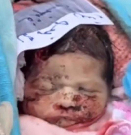 هذه الطفلة احد ضحايا القصف الهمجي الإسرائيلي امس  اسمها وتين الخباز.

كما يظهر، أصابت احدى الشظايا رأس واتين.

استشهدت واتين مع والدها ووالدتها وجدتها وابنة عمها هذي الطفلة تبلغ من العمر خمسة أشهر فقط.