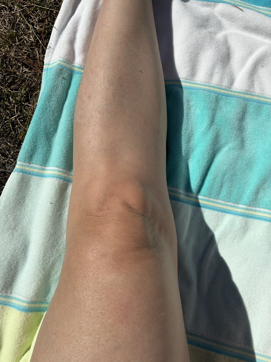 autonomiccalm's tweet photo. Hypermobile knee = extends past neutral due to loose ligaments.

• Knee bends “backwards” 
• Feels unstable 
• Common for hEDS or HSD
• Can cause hip/back/knee pain
• Strengthen quads/hamstrings
• PT for hypermobility

Your body needs the right support. 💛 #hsd #yogatherapy https://t.co/3Tz7WvPFNJ