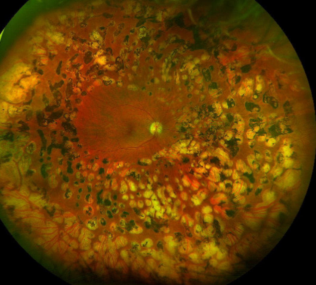 RetinaSociety's tweet photo. Regressed proliferative diabetic retinopathy following panretinal laser photocoagulation. https://t.co/29CpaO3ntG