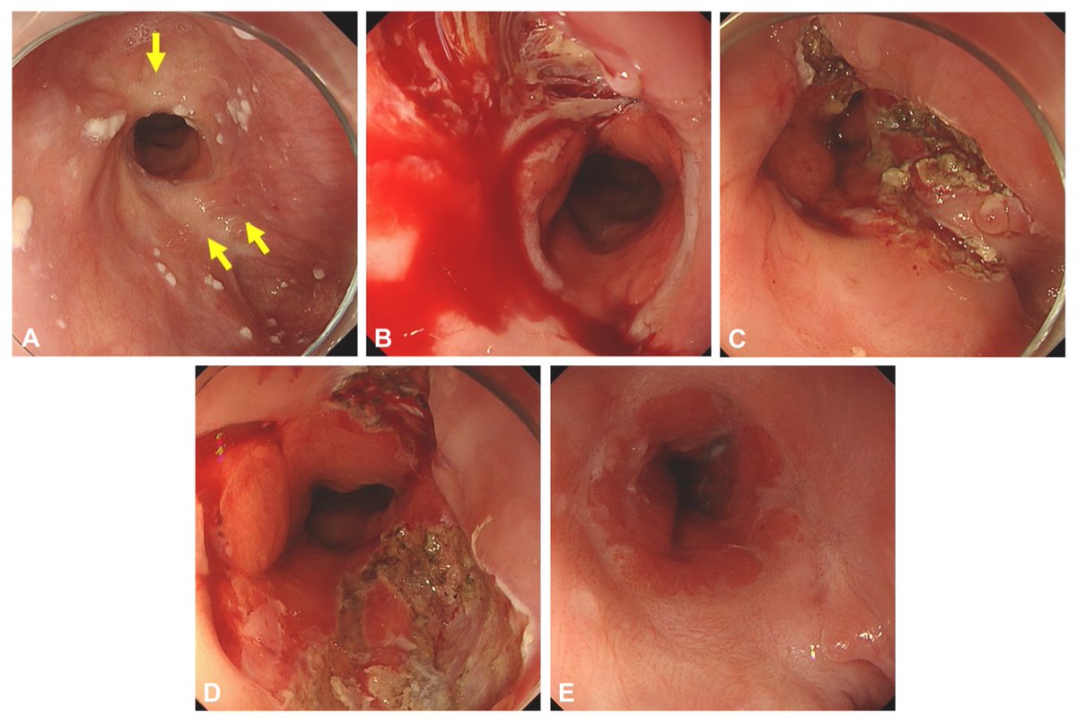 AchintyaSinghMD's tweet photo. Incision of esophageal strictures for management of refractory surgical / ESD strictures : https://t.co/zrAQenPM8A

🪙Focus on the areas that are not disrupted during dilation 
🪙Linear incisions for fibrotic bands
🪙Balloon dilation +/- steriod injection after 
👎6 cases only https://t.co/dF9Yn55XHc