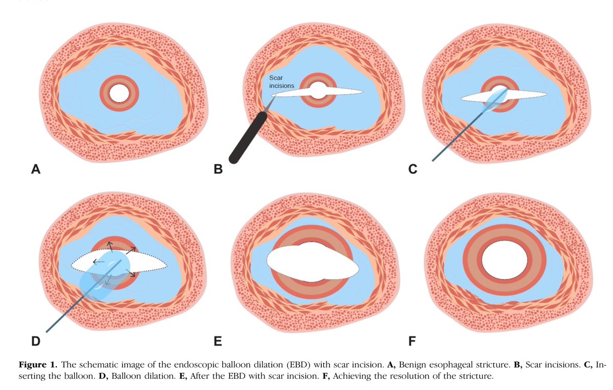AchintyaSinghMD's tweet photo. Incision of esophageal strictures for management of refractory surgical / ESD strictures : https://t.co/zrAQenPM8A

🪙Focus on the areas that are not disrupted during dilation 
🪙Linear incisions for fibrotic bands
🪙Balloon dilation +/- steriod injection after 
👎6 cases only https://t.co/dF9Yn55XHc
