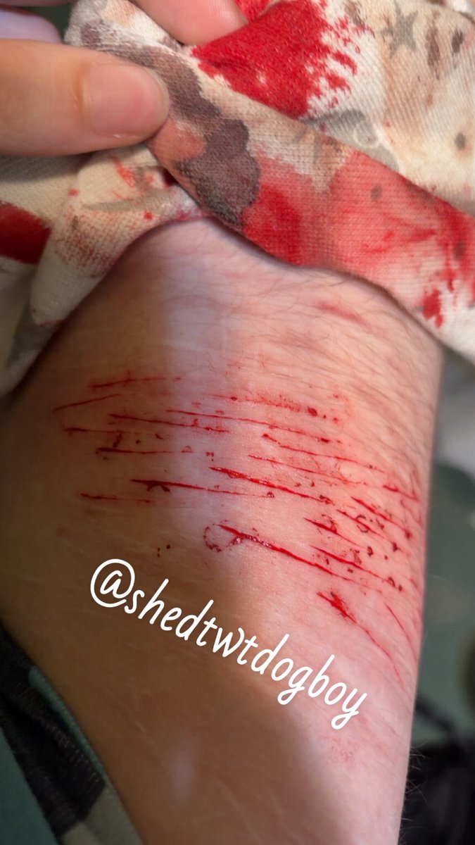 shedtwtdogboy's tweet photo. something abt that i was almost 4 months clean

#shedtwt #shtwt #988twt #raspberryfilling #raspberryfillingtwt #styro #catscratches 

my leg looks skinny in the first pic 🤩 https://t.co/gAoYeuT91s