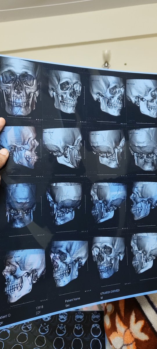 Unique_utkarshd's tweet photo. Student of ABES Engineering College, Ghaziabad. On 2 Feb 2026 (9:40 AM), I was assaulted without provocation inside campus, allegedly due to the warden’s son’s influence. My jaw was dislocated with fractures; surgery advised. No police action till now. https://t.co/wkX1B6va1s