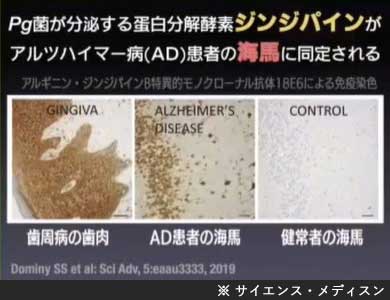 【アルツハイマーの原因】

→ 歯周病の黒幕ジンジバリス菌と
分泌される分解酵素ジンジパインだった！

これらの働きを阻害したら進行が低下した
研究あり

ジンジバリス菌はココアで短時間で検出不能になる

という事は

ココアは予防、進行の低下が期待できるという事！

comet-1.com/nayami/answer/…