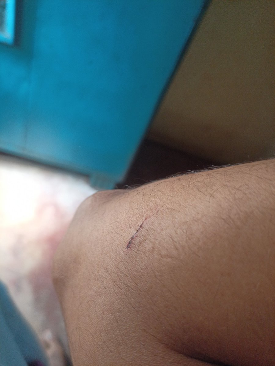 അയ്യോ മുറിഞ്ഞു വേദനിക്കുന്നു അവസ്ഥാ തന്നെ 🥹😦
