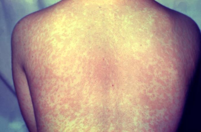 V Jeruzalémě zemřelo na spalničky roční dítě, je to už čtrnácté úmrtí v důsledku epidemie.
Jde o čtrnáctý případ úmrtí v epidemii, která zasáhla ultraortodoxní komunity a oblasti s nízkou proočkovaností.
tinyurl.com/235hbr4w