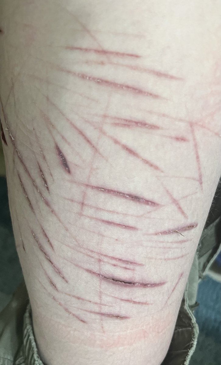 CorvusCorvusCor's tweet photo. FOR #shtwt or #shedtwt users that are well versed in beans level after care: please send advice &amp; help my way to make sure im doing this correct 

This is on my right thigh, showing all the cuts so u get an idea of the general area&amp;stuff
theyre abt a week old i think?
+cat at end https://t.co/UxGA54npfD