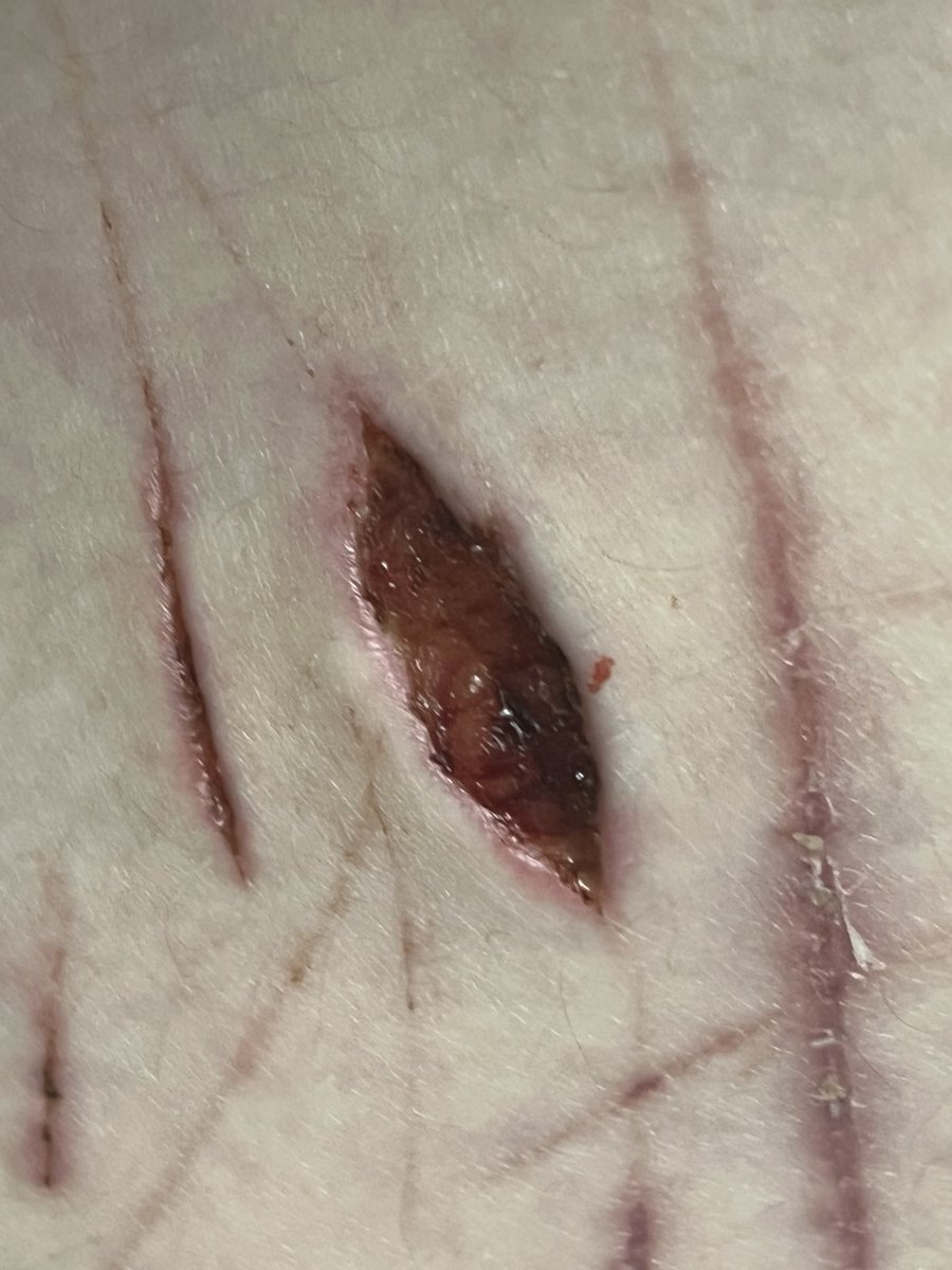 CorvusCorvusCor's tweet photo. FOR #shtwt or #shedtwt users that are well versed in beans level after care: please send advice &amp; help my way to make sure im doing this correct 

This is on my right thigh, showing all the cuts so u get an idea of the general area&amp;stuff
theyre abt a week old i think?
+cat at end https://t.co/UxGA54npfD