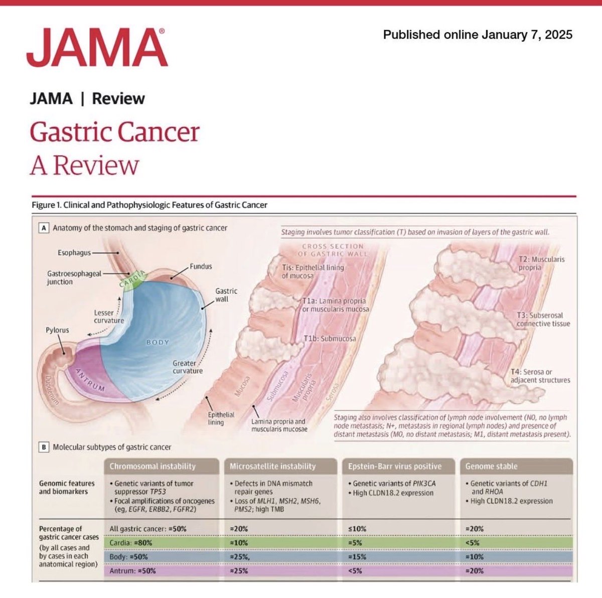 ShandaBlackmon's tweet image. Excellent review of #GastricCancer risk factors, including #microsatellite instability, #EBV (Epstein Barr Virus), genetic factors &amp;amp; #ChromosomalInstability