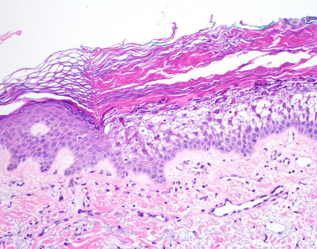 JMGardnerMD's tweet photo. Focal finding in BCC excision. What is it?
Answer✅ https://t.co/6iEWrQiQ32
More cases🔬https://t.co/WaPB2UBh5j &amp; https://t.co/kQla9FtPyc
#pathology #pathologists #pathTwitter #dermpath #dermatology #dermtwitter https://t.co/atfmzl9iKA