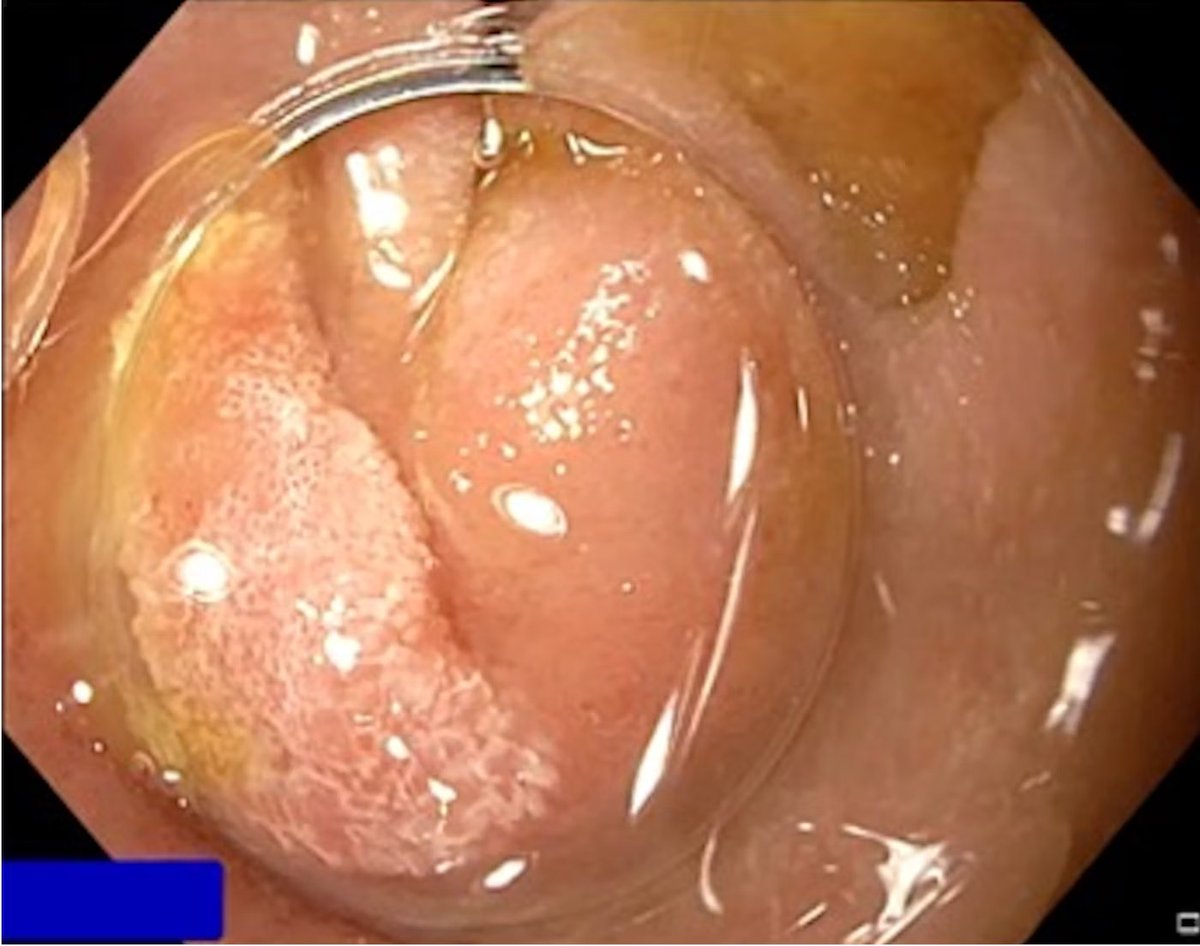 EndoCollab™ | GI Endoscopy Community tweet media