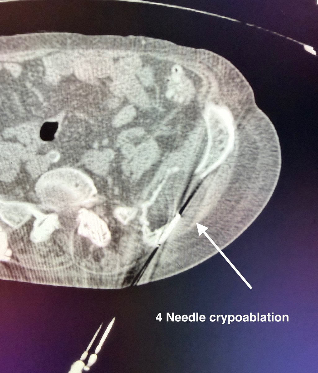 AustinBourgeois's tweet image. Ct-guided cryoablation of a large iliac bone lytic lesion.  Created an 8cm iceball with 4 IceForce probes, actively thawed center and used marginal ice to contain cement.  #iRad
