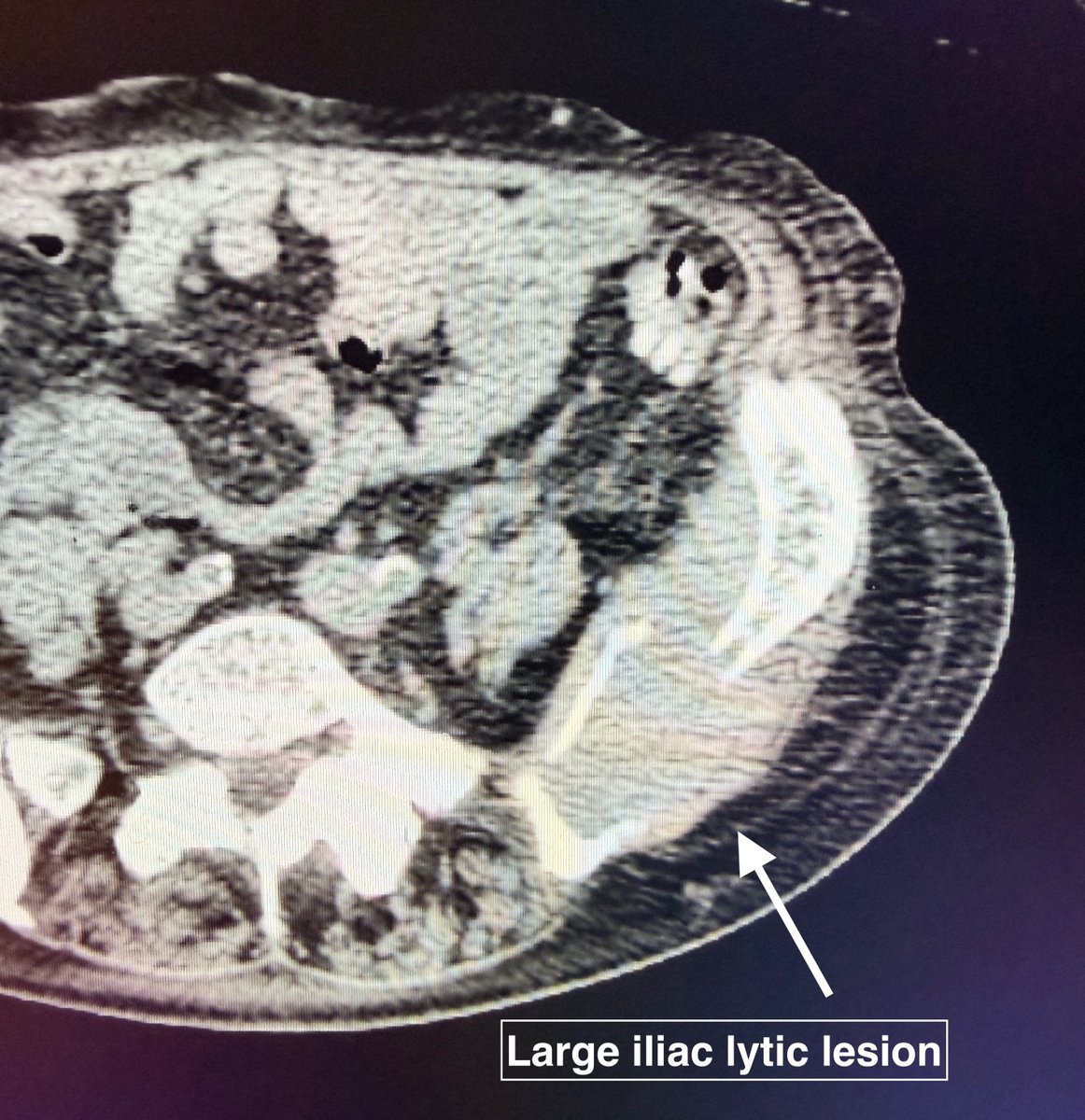 AustinBourgeois's tweet image. Ct-guided cryoablation of a large iliac bone lytic lesion.  Created an 8cm iceball with 4 IceForce probes, actively thawed center and used marginal ice to contain cement.  #iRad
