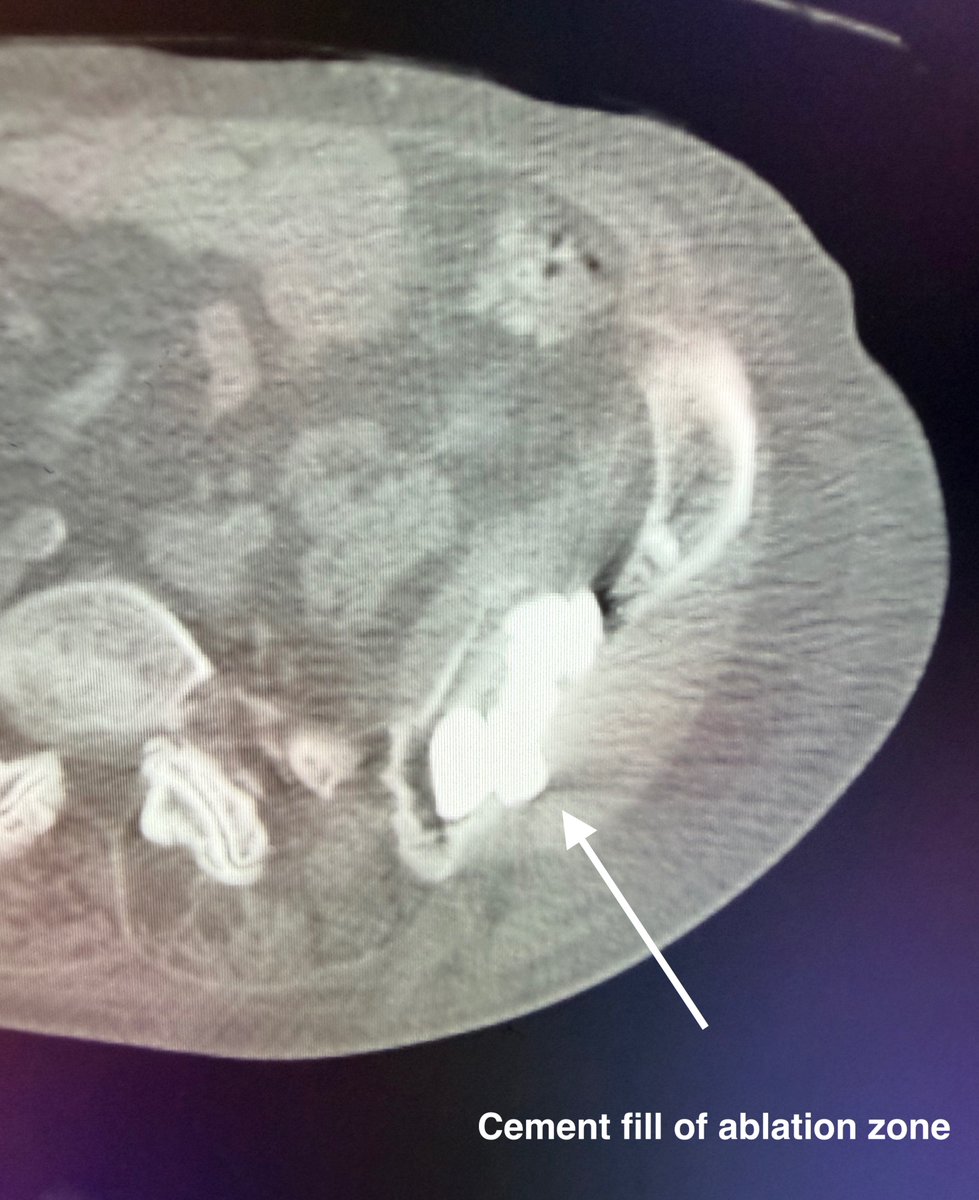 AustinBourgeois's tweet image. Ct-guided cryoablation of a large iliac bone lytic lesion.  Created an 8cm iceball with 4 IceForce probes, actively thawed center and used marginal ice to contain cement.  #iRad