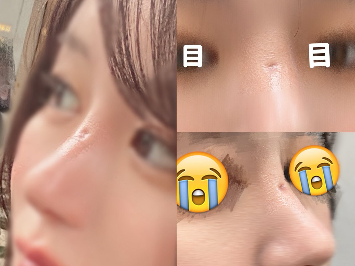 seikei_30's tweet image. 昨日クリニック行くも専門医に診てもらった方がいいとのことで明日紹介された病院に行くことに🏥
陥没してきたところは治せるなら治す方向で、厳しそうならチャームポイントに無理やりする🔥
整形って本当リスクが付きものだし、自己責任の世界だ