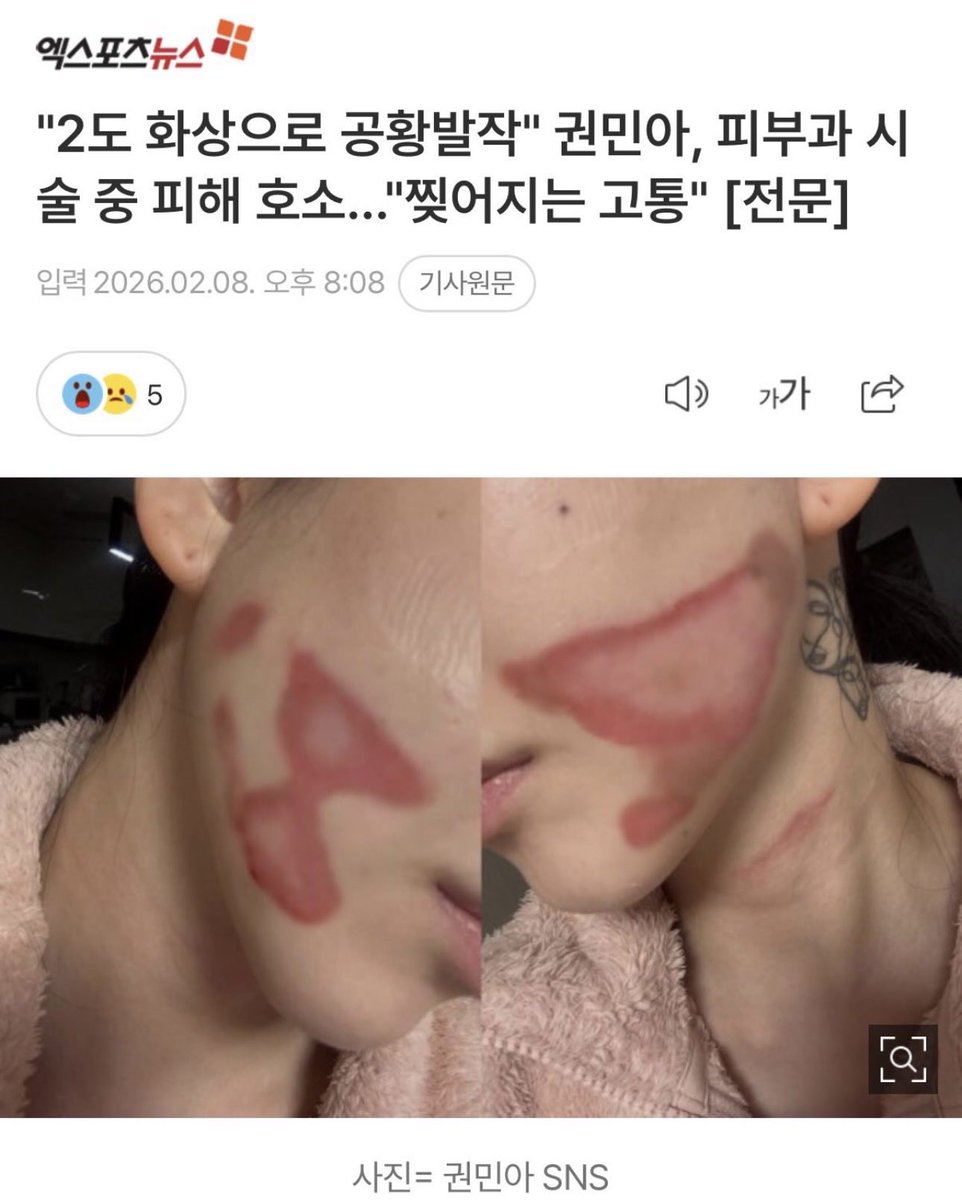 dermtae's tweet image. 울쎄라 아닌, 
약하다고 생각하는 국산 HIFU도 화상가능!

병원 주장대로 팁불량일수도 있지만
1) 같은 부위 많은 샷 중첩 
2) 수면시술 특성상 움직이면서, 팁이 밀착안되는 경우
도 충분히 hifu에 의해 화상 가능합니다.

너무 안타깝네요 색소침착 오래갈것 같은데😢