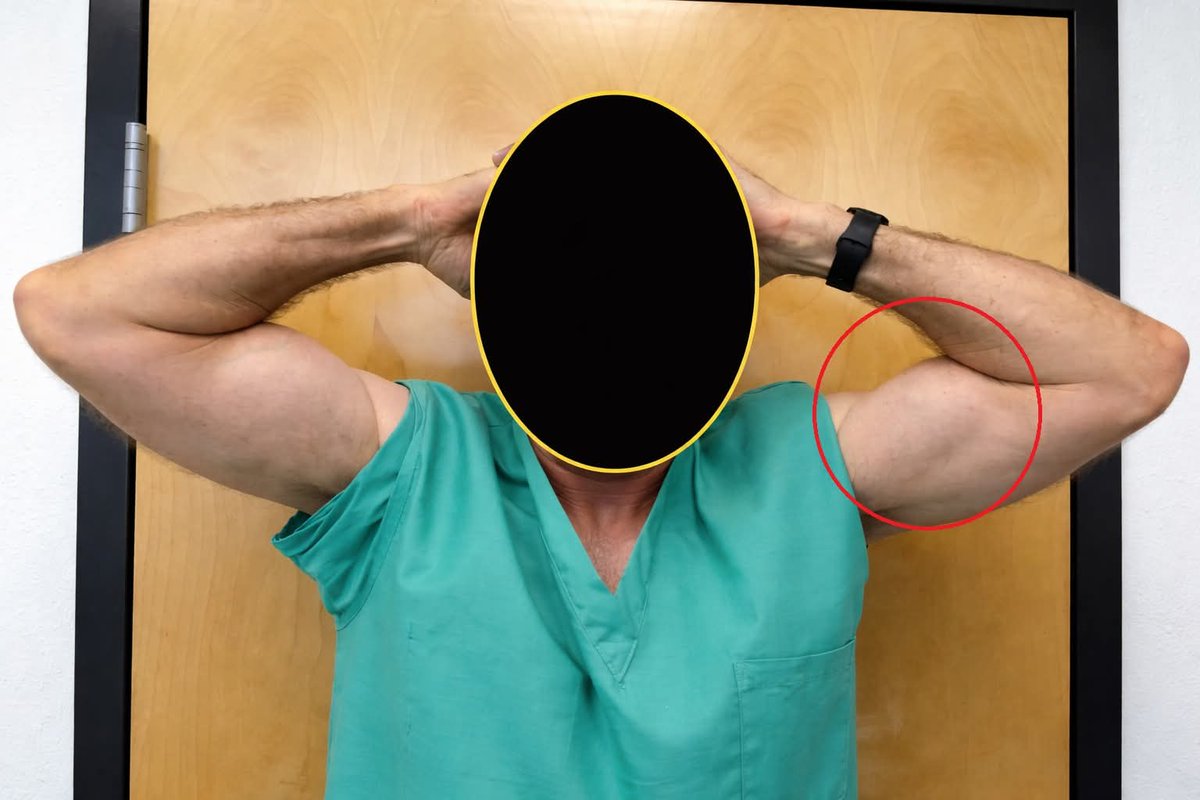 eweda_reda's tweet photo. Ludington’s test evaluates for rupture of the long head of the biceps tendon. 
The patient places both hands on top of the head with the palms facing downward and then simultaneously contracting the biceps muscles. https://t.co/8dQ1wr0X2L