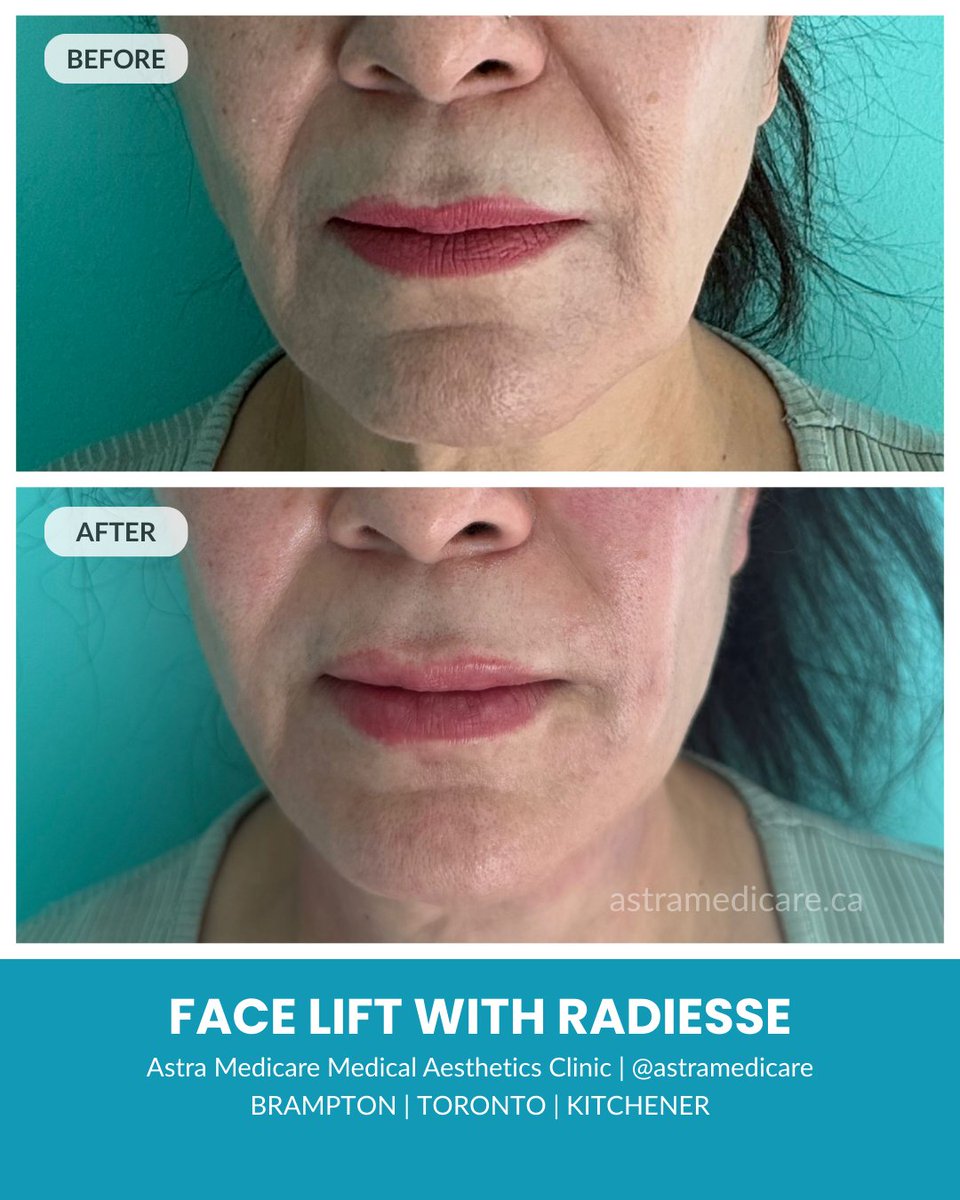 𝑾𝒂𝒏𝒕 𝒂 𝒍𝒊𝒇𝒕𝒆𝒅, 𝒇𝒓𝒆𝒔𝒉-𝒍𝒐𝒐𝒌𝒊𝒏𝒈 𝒇𝒂𝒄𝒆 𝒘𝒊𝒕𝒉𝒐𝒖𝒕 𝒔𝒖𝒓𝒈𝒆𝒓𝒚? 𝑻𝒉𝒊𝒔 𝒃𝒆𝒇𝒐𝒓𝒆 𝒂𝒏𝒅 𝒂𝒇𝒕𝒆𝒓 𝒔𝒂𝒚𝒔 𝒊𝒕 𝒂𝒍𝒍 ✨

This result shows a non-surgical facelift using Radiesse. Radiesse helps your skin make more collagen, which can improve