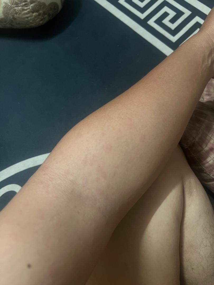 acaiberi94's tweet photo. Tukar ubat baru ni habis satu badan gatal2 ni,dah la esok nak keja tak boleh tidur hari ni lain macam gatal dia😩 https://t.co/BBdQjAEV8x