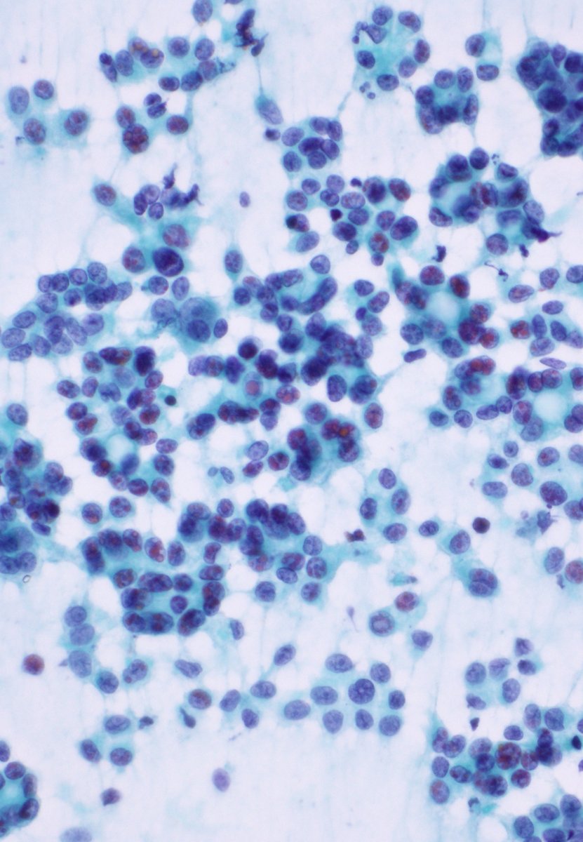 DrCycloPath's tweet image. #CytoQuiz #Pancreas
Diagnosis?🧐
A) Solid Pseudopapillary Neoplasm
B) Pancreas Acinar Cells
C) Neuroendocrine Tumor
D) Acinar Cell Carcinoma
#CytoPath