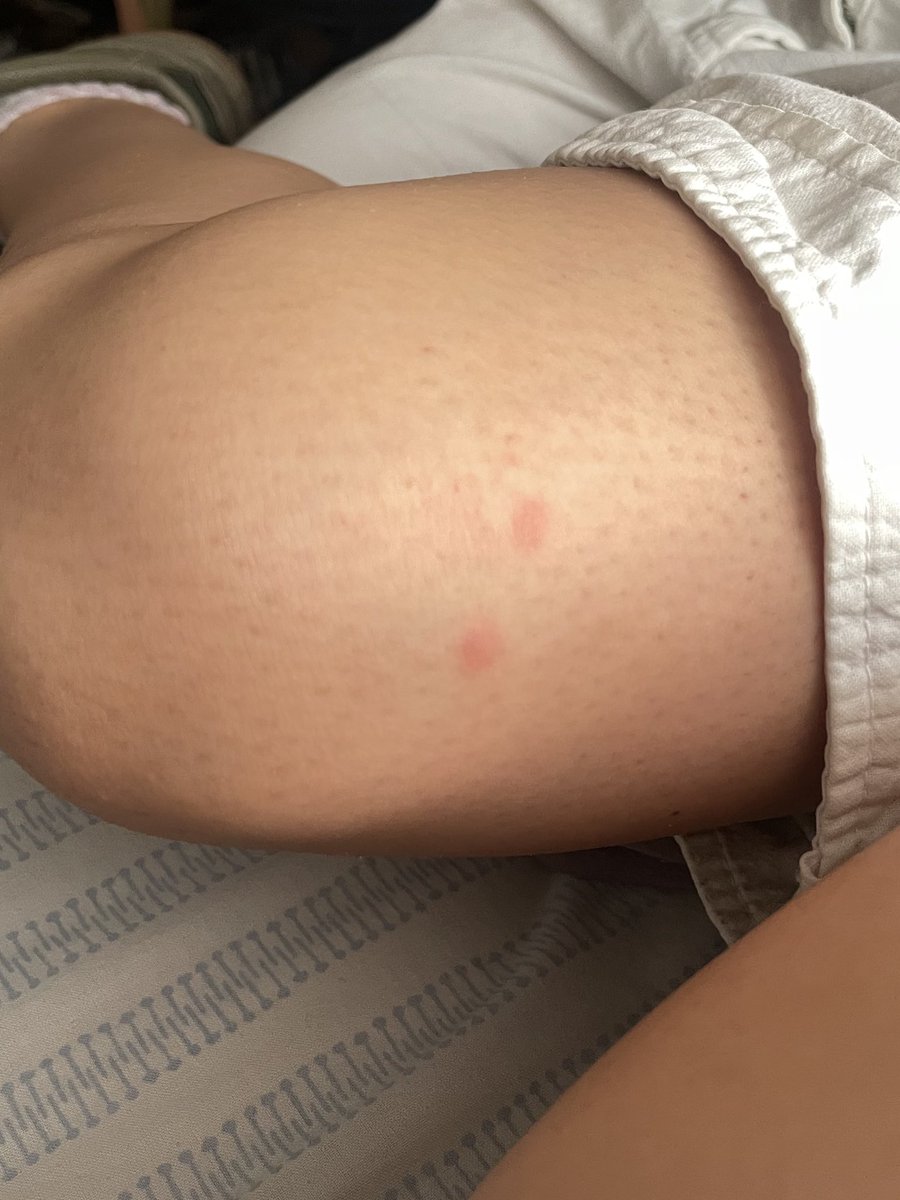 luuvdiazz's tweet photo. si mi amor somos esas dos picaduras de mosquito en tu pierna https://t.co/dW57yPmyCL