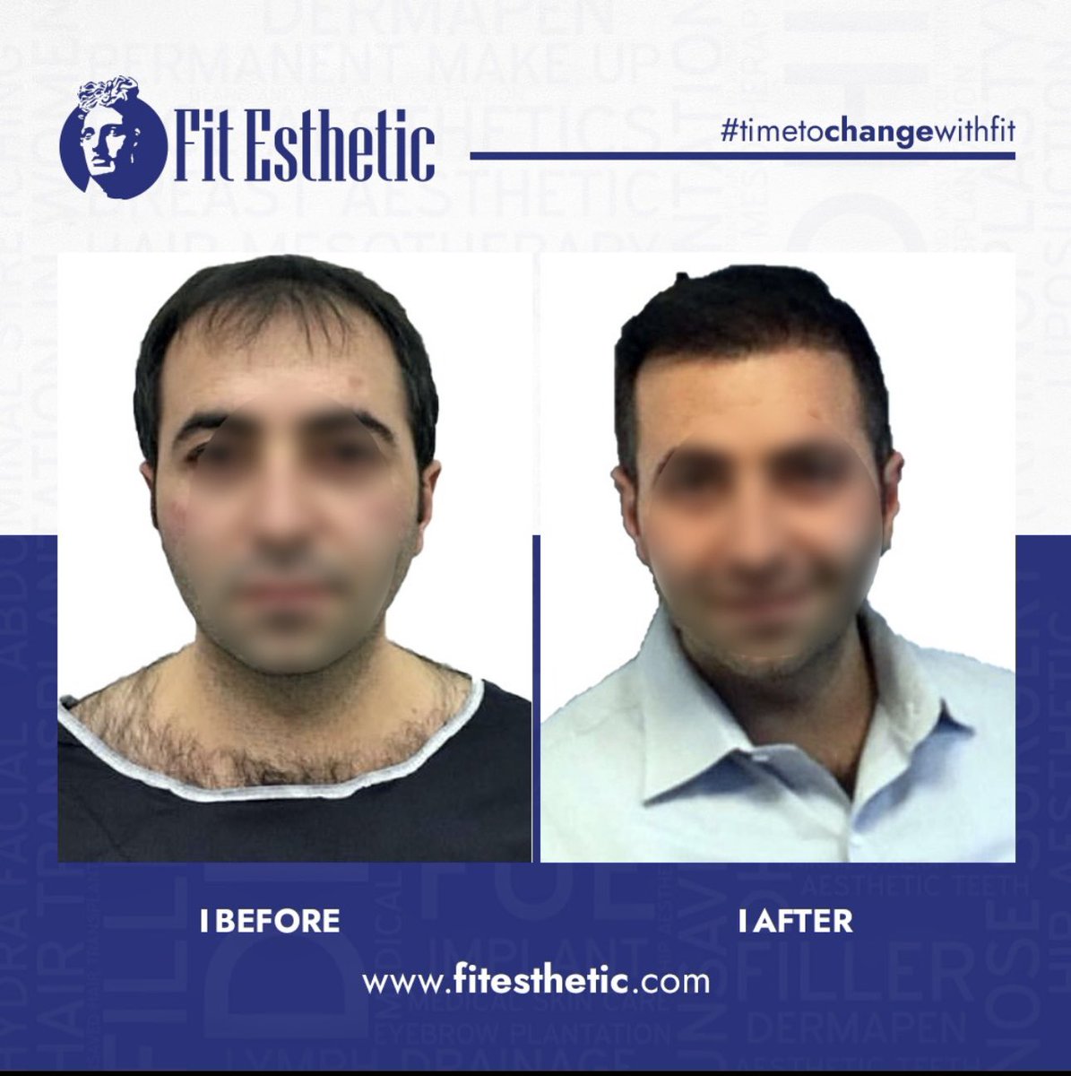 Fit_Esthetic's tweet photo. Proper planning, the right technique, a professional surgical team, and successful results.
Every stage is important in hair transplantation.
#SaçEkimi
#HairTransplant
#Trapiantodicapelli
#Greffedecheveux
#Haartransplant
#Haartransplantatie https://t.co/MAbkYn0PKq