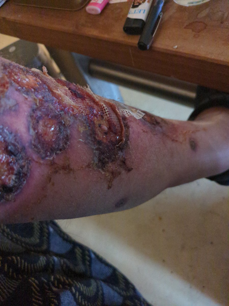 iwillstand04's tweet photo. Putain j'ai mal à mes plaies c'est atroce.. https://t.co/cTAMGHpJ47