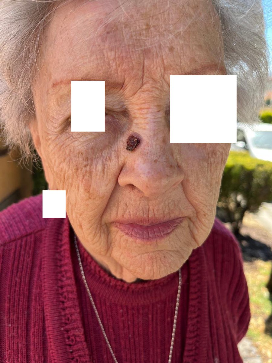 eltio01's tweet photo. Mas como catarsis que como caso, les comparto ésto:
 Es una amiga de mi madre, pensionada del IMSS, que no tiene dinero para operarse en privado éste carcinoma basocelular. 
Fue al @Tu_IMSS @IMSS_Bienestar  y le dijeron que como ya está grande ... https://t.co/RrqMKwqih4