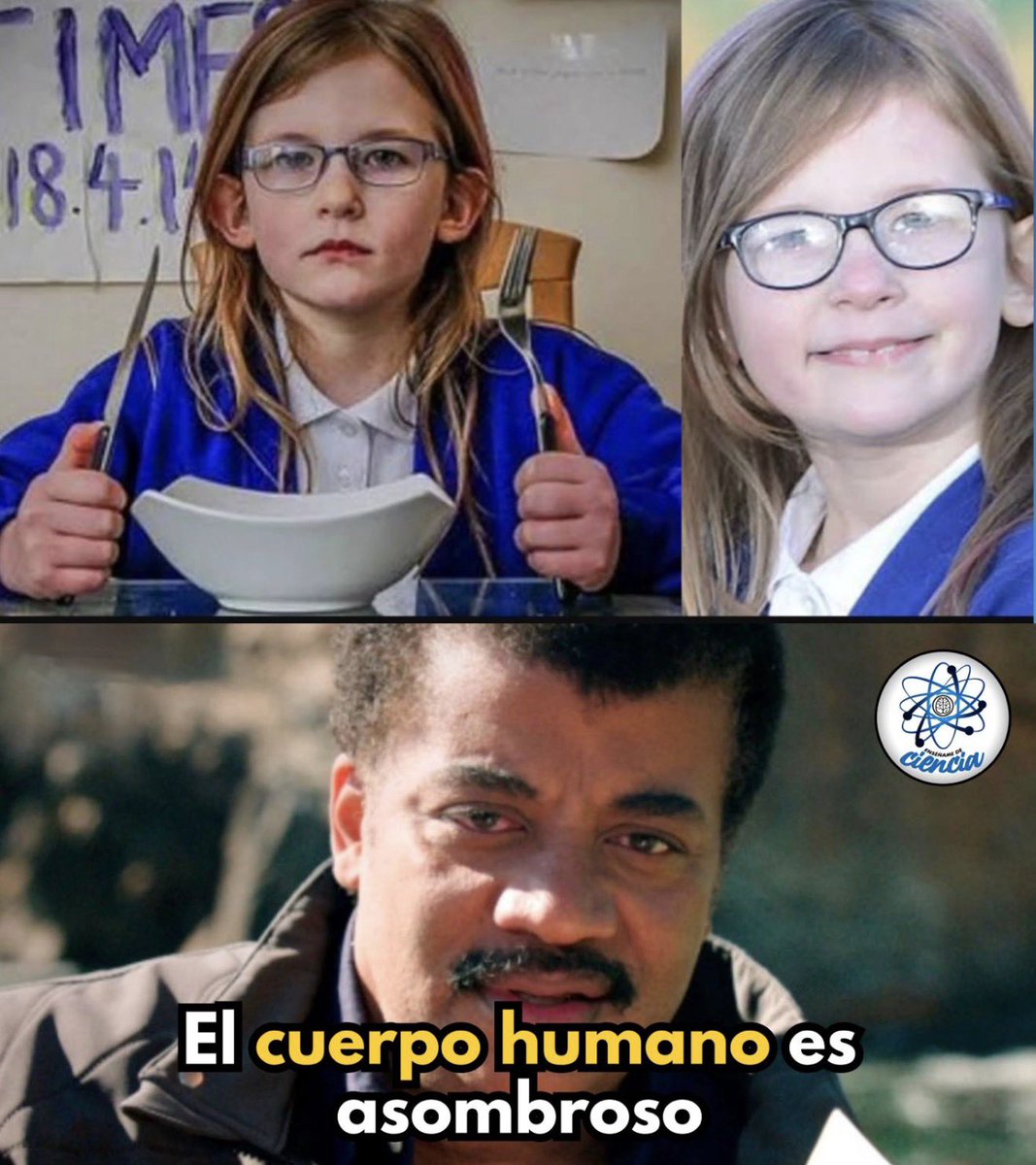 EnsedeCiencia's tweet photo. Olivia es una niña británica con una rarísima alteración genética en el cromosoma 6, asociada a una microdeleción que afecta funciones básicas del cuerpo humano. Su caso llamó la atención de médicos y científicos porque combina tres condiciones extremadamente inusuales:

🔹 Insensibilidad al dolor: puede sufrir lesiones graves sin sentirlo, lo que la expone a riesgos constantes.
🔹 Ausencia de hambre: puede pasar largos periodos sin comer porque su cerebro no envía la señal de apetito.
🔹 Alteraciones del sueño: necesita muy pocas horas de descanso y puede permanecer despierta durante días sin mostrar fatiga evidente.

Este tipo de combinación es extraordinariamente rara y sigue siendo objeto de estudio, ya que ayuda a comprender cómo el cerebro regula sensaciones fundamentales como el dolor, el hambre y el sueño.

🧬 El caso de Olivia no es “superpoderes”, sino un recordatorio de lo complejo y asombroso que es el cuerpo humano, y de lo delicado que puede ser cuando uno de sus engranajes falla.