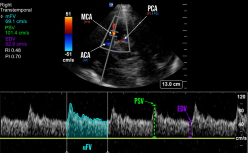 EmergPOCUS's tweet photo. 🧠 Cómo usar el Doppler transcraneal en urgencias (sin complicarte) paso a paso 🧵

Es una herramienta:
• No invasiva
• Rápida
• Repetible
• En tiempo real

Su aplicación mejor estudiada 👇
👉 Vasoespasmo de la arteria cerebral media en HSA

📊 Comparado con angio-TC:
• Sensibilidad y especificidad 89–98%
• Excelente herramienta de monitorización a la cabecera

🧠 Además puede ayudar en:
• PIC elevada
• Desplazamiento de línea media
• EVC
• TCE (pronóstico)

📌 Ideal en pacientes inestables o con recursos limitados.

#Emergencias #POCUS #Neurocríticos #Urgencias #MedicinaCrítica
