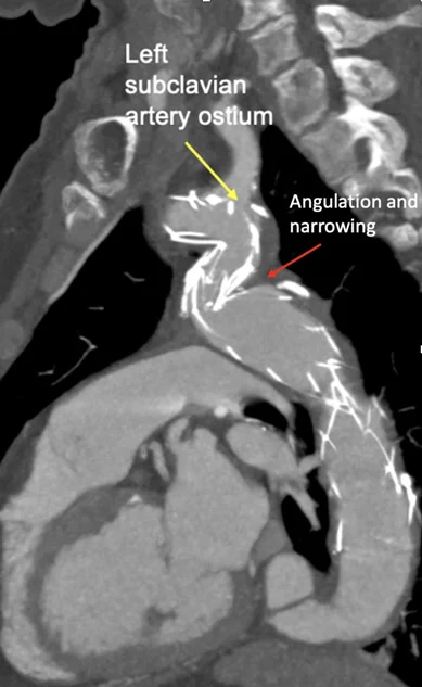 TagliariPaula's tweet photo. Challenging anatomy during TAVI? π€
See how we solved it in Part 2 of this clinical case on #PCRonline
π Alternative access strategies + expert insight from @deharo_pierre
πhttps://t.co/uHzKu7wCoP
@PCRonline
#TAVI #TAVR #Cardiology #structuralheartintervention #coarctation #aorta #alternativeaccess #CardioX