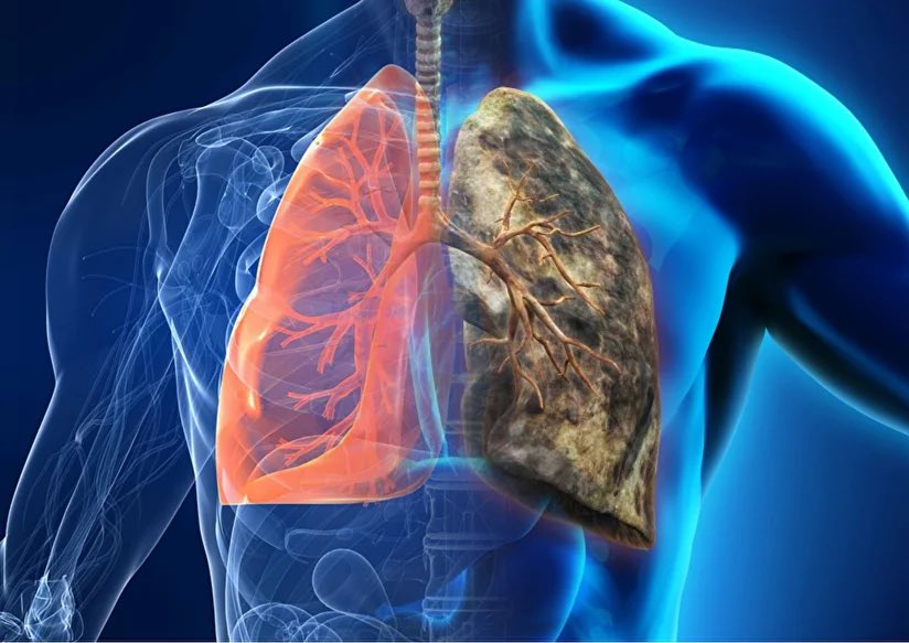 🚨: Doctors in Cuba develop lung cancer.