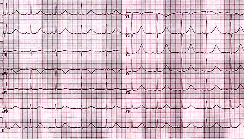 A 24-year-old woman presents with recurrent syncopal episodes triggered by sudden loud noises.

Family history reveals a cousin who died suddenly at 18 years of age.

No structural heart disease on echocardiography

Which of the following is the most appropriate long-term