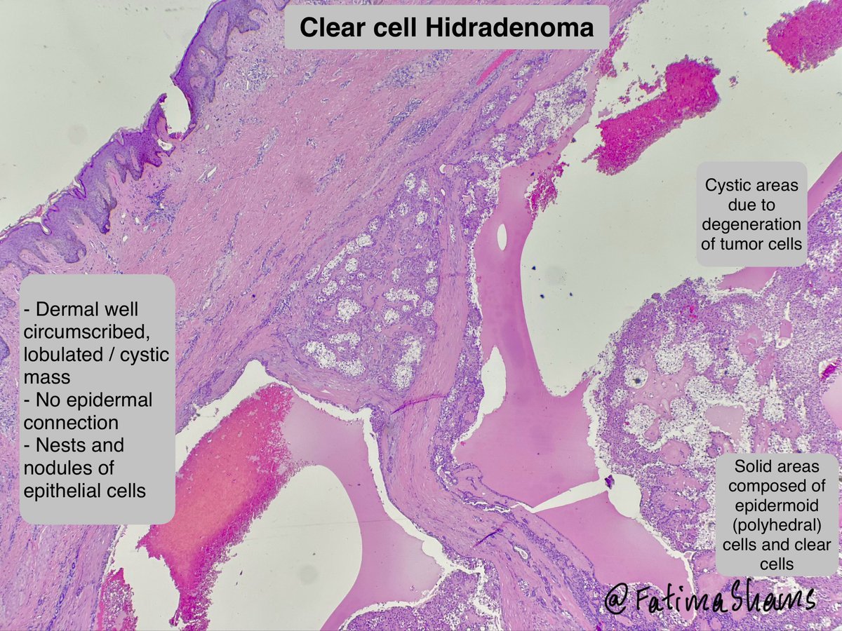 FatimaShamsPath's tweet photo. 🎯 Clear cell hidradenoma
 
👉 64-year-old male with right arm soft tissue swelling
 
🔬Histology highlights:- 
•Well-circumscribed dermal tumor
•Solid and cystic architecture
•Lobules of epithelial cells in hyalinized stroma
•Prominent clear cells with glycogen-rich cytoplasm
•Evidence of ductal differentiation

PanCK and EMA positivity shows epithelial and highlights ductal differentiation 
 
🔎 Key differentials:- 
•Metastatic renal cell carcinoma
•Poroma / poroid hidradenoma
•Hidradenocarcinoma
•Clear cell squamous cell carcinoma
 
💎 How to distinguish
•Lack of infiltrative growth, necrosis, and significant atypia
•Presence of ductal structures and biphasic cell population
•Clinicopathologic correlation is essential

⚓️ Prognosis
•Benign tumor
•Excellent prognosis after complete excision
•Local recurrence possible if incompletely excised
 
#PathTwitter #Dermatopathology #SkinAdnexalTumor #Hidradenoma #PathologyCase