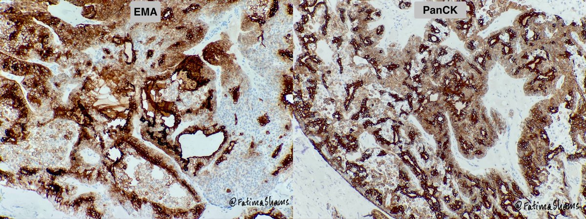FatimaShamsPath's tweet photo. 🎯 Clear cell hidradenoma
 
👉 64-year-old male with right arm soft tissue swelling
 
🔬Histology highlights:- 
•Well-circumscribed dermal tumor
•Solid and cystic architecture
•Lobules of epithelial cells in hyalinized stroma
•Prominent clear cells with glycogen-rich cytoplasm
•Evidence of ductal differentiation

PanCK and EMA positivity shows epithelial and highlights ductal differentiation 
 
🔎 Key differentials:- 
•Metastatic renal cell carcinoma
•Poroma / poroid hidradenoma
•Hidradenocarcinoma
•Clear cell squamous cell carcinoma
 
💎 How to distinguish
•Lack of infiltrative growth, necrosis, and significant atypia
•Presence of ductal structures and biphasic cell population
•Clinicopathologic correlation is essential

⚓️ Prognosis
•Benign tumor
•Excellent prognosis after complete excision
•Local recurrence possible if incompletely excised
 
#PathTwitter #Dermatopathology #SkinAdnexalTumor #Hidradenoma #PathologyCase