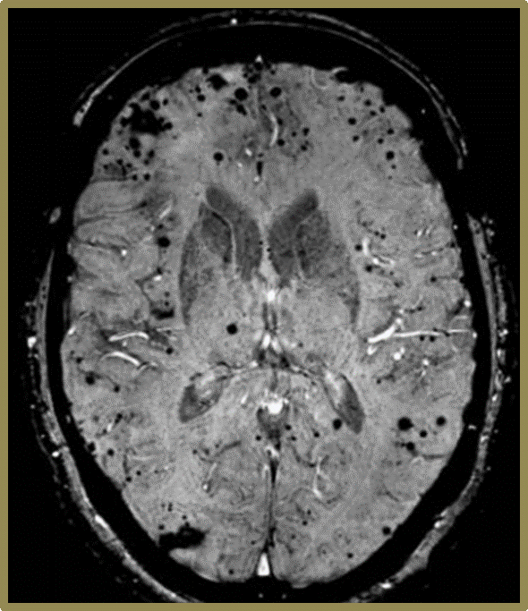 Hewxi_'s tweet photo. Its crazy to go from "yo bro whats the longest bone in the body?" to "In an susceptibility-weighted imaging MRI, what are the key findings for a diffuse axonal injury?" istg im going insane atp https://t.co/OOUWWLoWOv