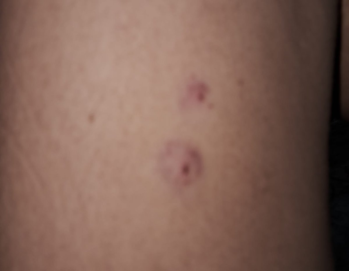 جای تزریق روی دست بازداشتی، به او گفته شده واکسن است و به زور به او تزریق شده، تاثیر داروها و تزریق گیجی، لختی و در آزمایش خون رقیق شدن خون گزارش شده و قرار است چندین نوبت آزمایش انجام شود 

Injection marks were observed on the detainee’s arm. She was told that the injection was