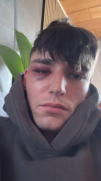 Pascal Káiser es el árbitro alemán que la semana pasada le pidió matrimonio a su novio en un estadio de fútbol.

Ayer 3 hombres le pegaron una brutal paliza en su casa.

Luego que si las personas LGTBI ya tenemos todo conquistado o que por qué tenemos que visibilizarnos.