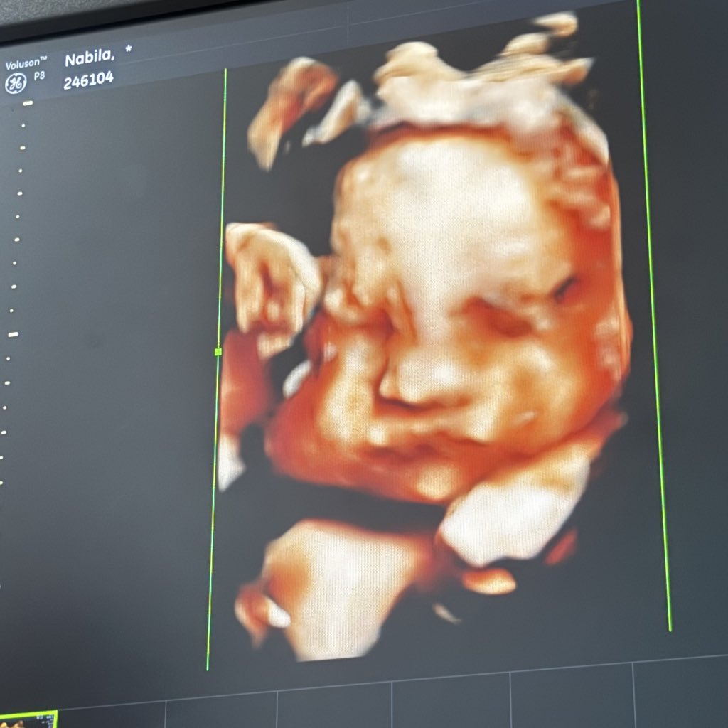 anak gue mirip nailong