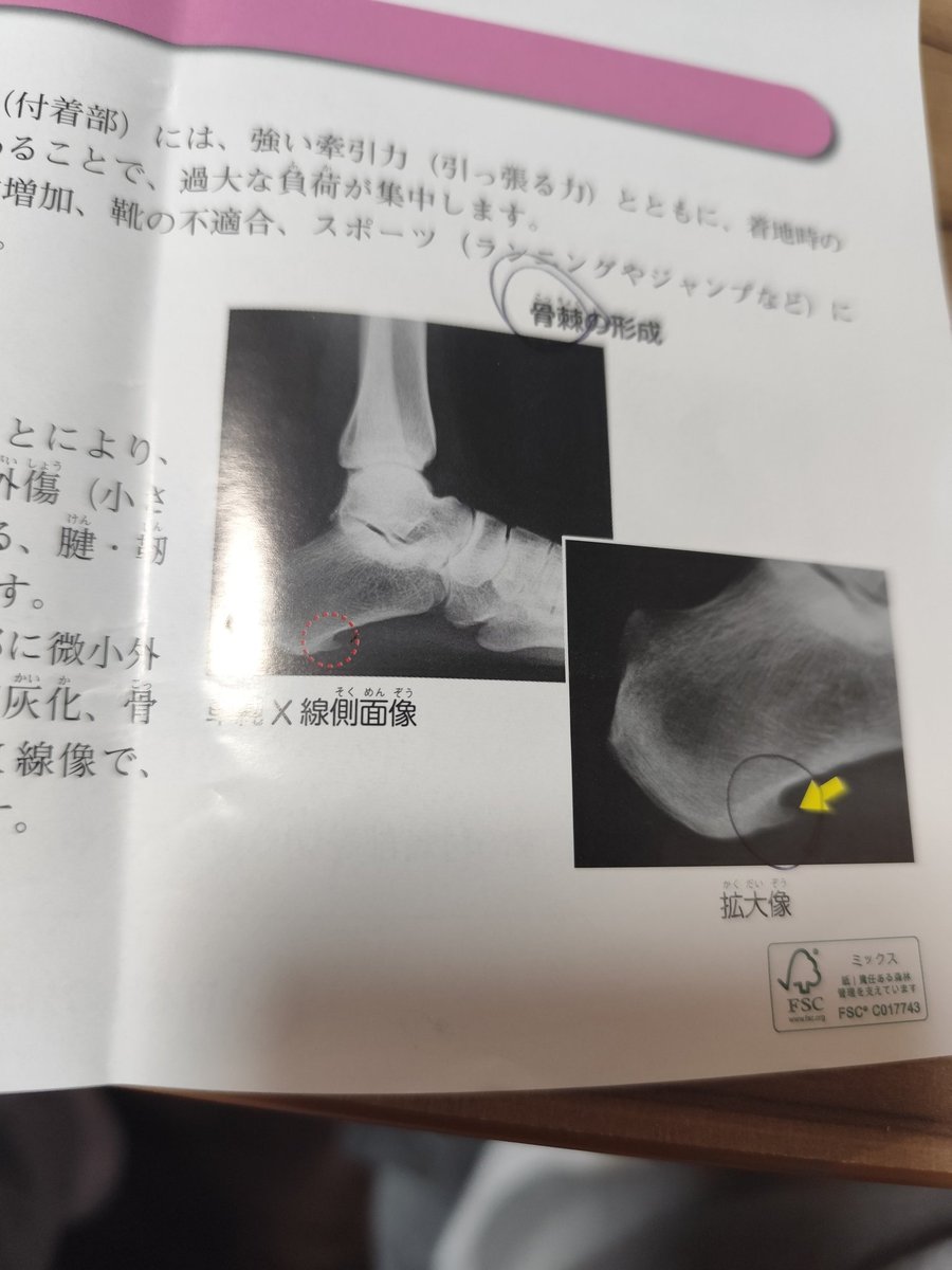 病院マニアな僕は、今日も病院へ。踵が痛いっての診てもらったらやっぱしコレ。骨が尖ってたわよー。
中々治らないらしいでー。ばかやろー😂