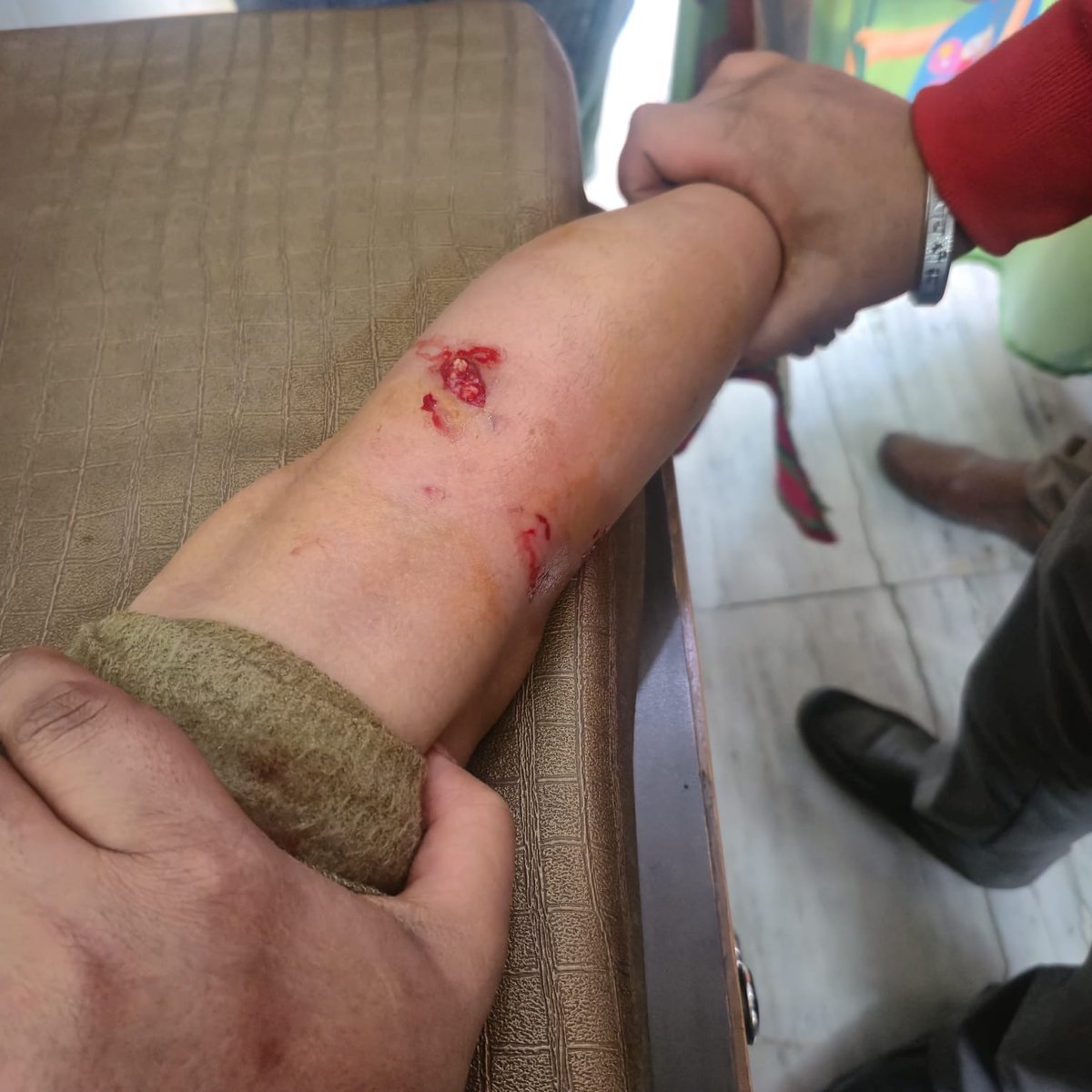 kumarpremsing's tweet photo. My 6yo son was brutally bitten by stray dogs in our society due to the gross negligence of the maintenance team &amp; a resident who feeds them in society public areas. Requesting urgent intervention. @Uppolice @ghaziabadpolice @dm_ghaziabad @ncpcr #childsafty #dogbite https://t.co/sXsGamDpKZ