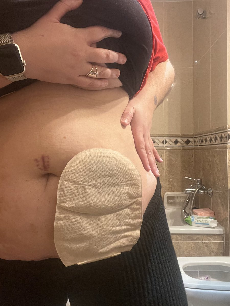 Iris Torrente | Ileostomia & inmunomediadas tweet media