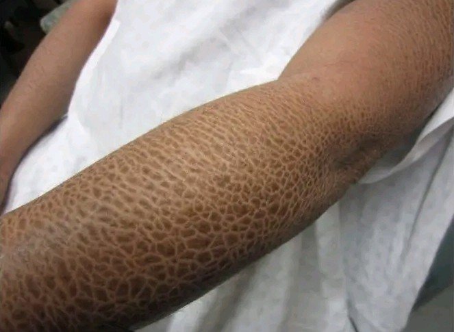 Dr_Chibuike_M's tweet photo. A 19-year-old male presents to the dermatology clinic with a long-standing history of dry, scaly skin mainly on his forearms and legs. 

The condition has been present since early childhood and tends to worsen during the dry Nigerian harmattan season. He has serious cosmetic concerns. 

There is no history of blistering, redness, or skin infection. He has no significant past medical history.

What do you think is going on here? 🤔