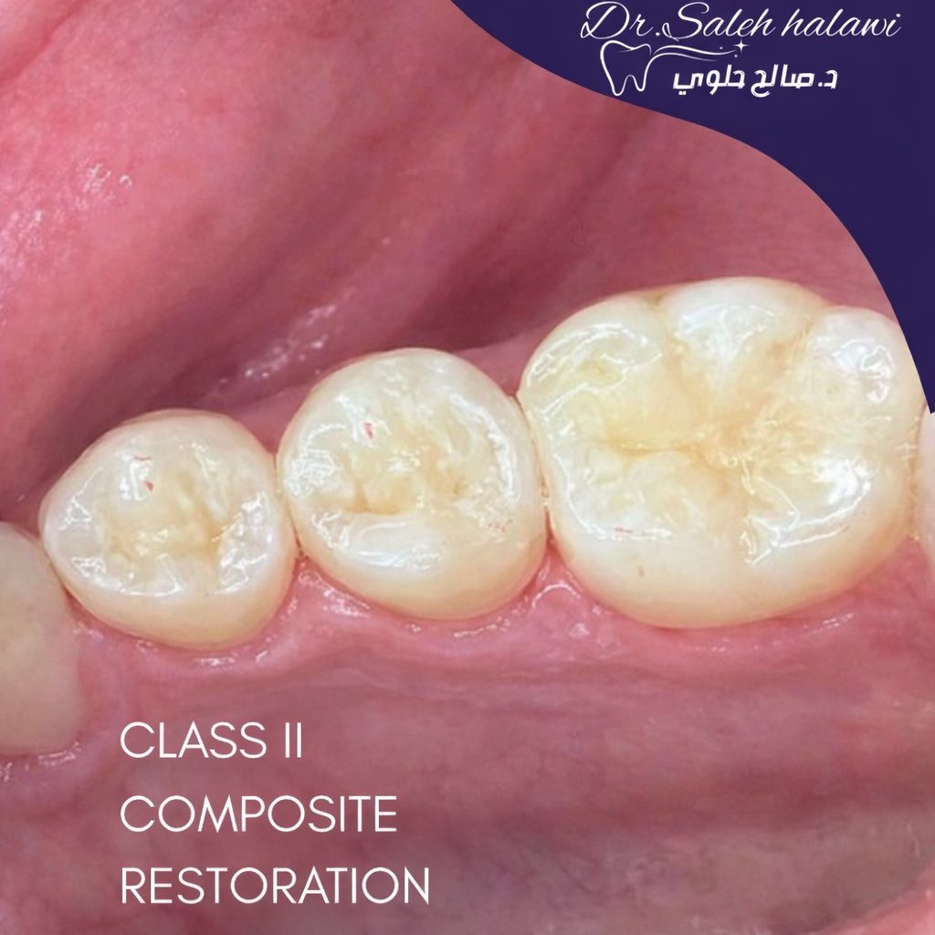 slo_s24's tweet photo. Class II composite restoration under rubber isolation, second CE IS DONE.✅
#operative #dentistry https://t.co/fLABcYByq9